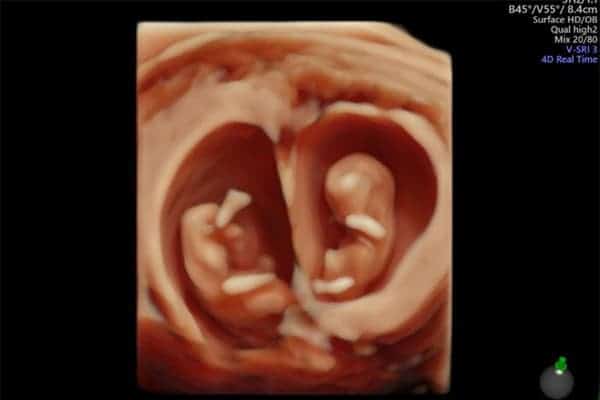 echographie grossesse gemellaire jumeaux echographiste obstetrical centre echographie obstetricale sevres babylone paris cesb