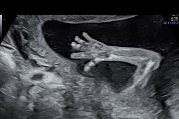 echographie morphologique precoce genetic scan 16 18 sa echographiste obstetrical centre echographie obstetricale sevres babylone paris cesb