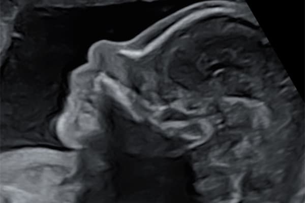 profil t2 echographie deuxieme trimestre grossesse centre echographie obstetricale sevres baylone cesb paris
