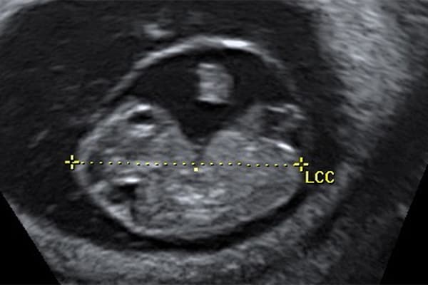 premiere echographie de grossesse echographie precose datation provisoire echographiste obstetrical centre echographie obstetricale sevres babylone paris cesb